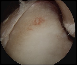 Inverted Pear Glenoid